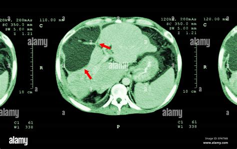 Ct Scan Abdomen Hi Res Stock Photography And Images Alamy