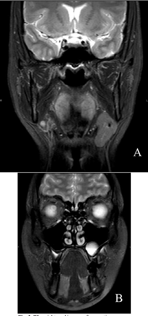 Figure 1 From Unilateral Submandibular Gland Aplasia With Ipsilateral