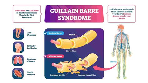 Syndrome De Guillain Barre