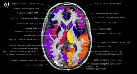 Projection bda/aav comparison transgenic characterization reference data brain explorer documentation help. 19 best Mitochondrial Disease images on Pinterest ...