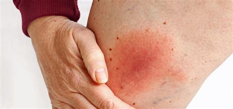Five Fast Facts About Cellulitis Skin Infections Gohealth Urgent Care