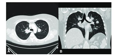 Chest Computed Tomography Scan Showed Several Round Or Lobular Nodules