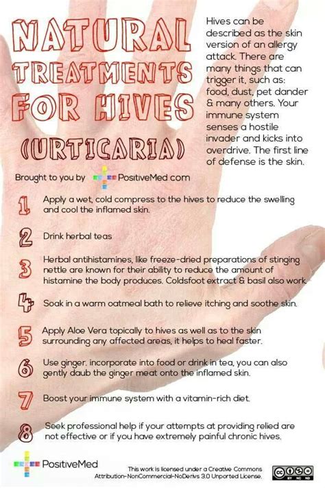 Hives Urticaria Home Remedies For Hives Hives Remedies Natural