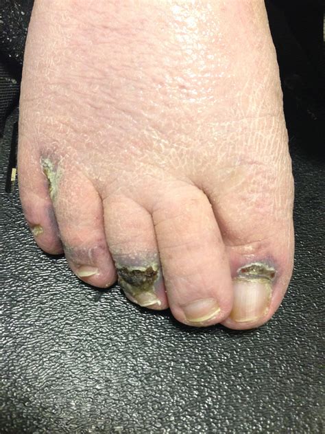 Blue Toes From Trauma Angiologist