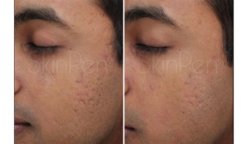 Pores And Acne Scars Houston Tx Chrysolite Aesthetics