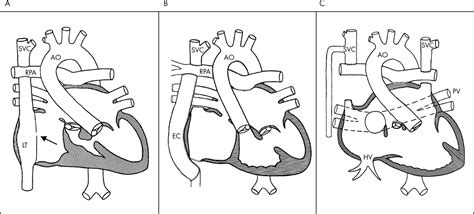 Kawashima Procedure Diagram Wiring Diagram Pictures