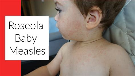 Roseola Baby Measles Signs And Symptoms Rash Youtube