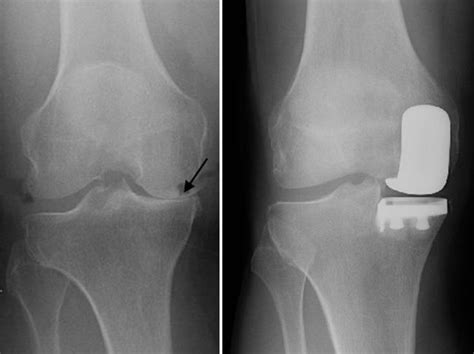 Unicompartmental Partial Knee Replacement Orthoinfo Aaos