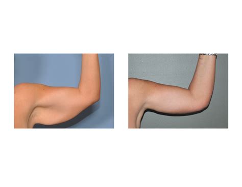 Combining Liposuction And Arm Lifts The Brachiolipoplasty Procedure
