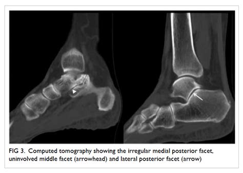 Posterior Facet Talocalcaneal Non Osseous Coalition An Uncommon But