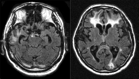 Parkinsons Disease Brain Mri Minimalistisches Interieur