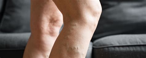 Vein Treatment Baltimore What To Expect The Vein Center Of Maryland