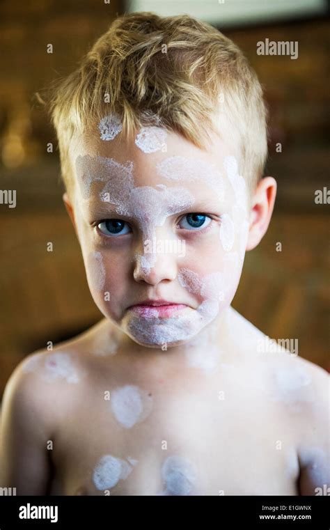 A Five Year Old Boy Being Treated With Calamine Lotion For Chicken Pox