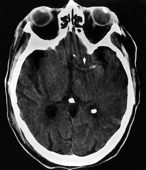 Acute Middle Cerebral Artery Thrombosis Demonstrated By Cranial