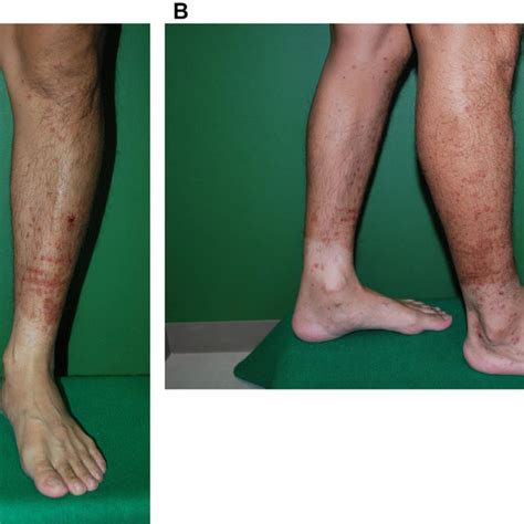 A B Palpable Purpura On The Lower Extremities Download Scientific