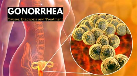 Gonorrhea Causes Signs And Symptoms Diagnosis And Treatment Youtube