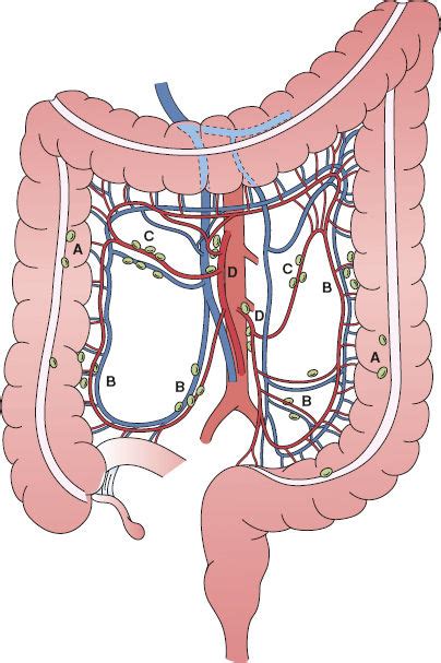 Colorectal Cancer Basicmedical Key