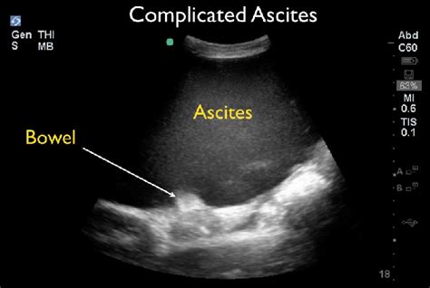 Ultrasound Image Of Echogenic Ascites Found In Complicated Ascites With