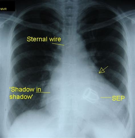 Prosthetic Heart Valves On Cxr All About Cardiovascular System And