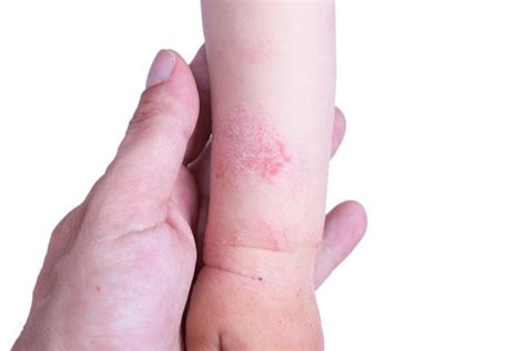 Understanding Eczema In Babies And How To Deal With It