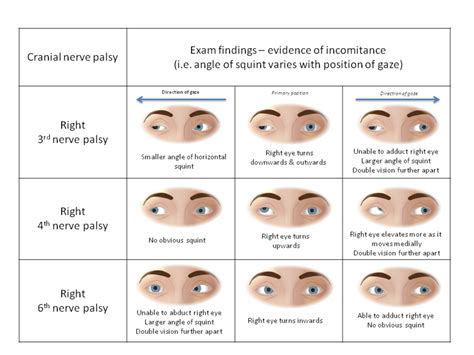 > cranial nerve i, also known as the olfactory nerve, is a special sensory nerve that is responsible for the smell. Double vision | The BMJ