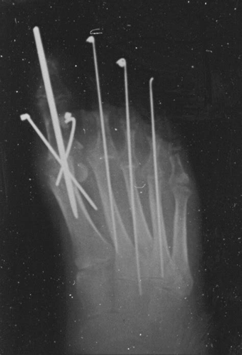 The Surgical Reconstruction Of The Rheumatoid Forefoot Clinics In