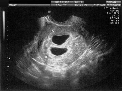 Ultrasound 6 Weeks Pregnant With Twins Belly Pregnantbelly