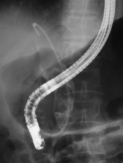 Biliary Stenting In The Management Of Large Or Multiple Common Bile