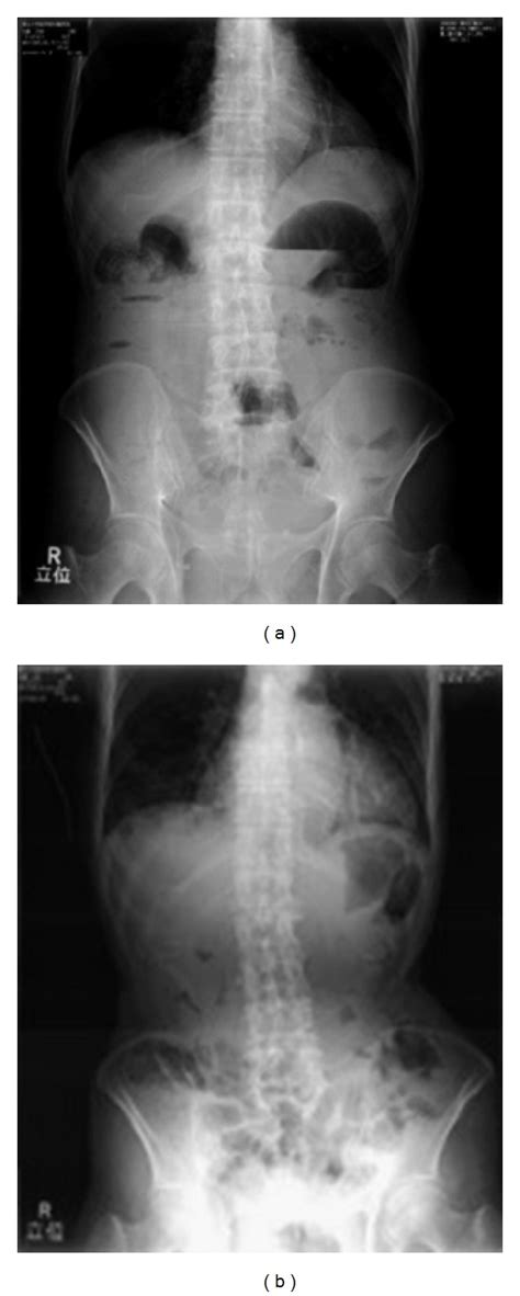 Abdominal X Ray Radiographs Of A 95 Year Old Paralytic Ileus Patient Download Scientific