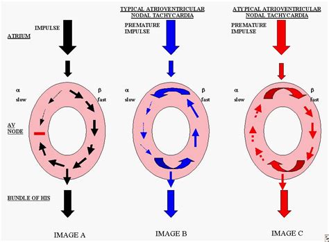 Atrioventricular Nodal Reentry Tachycardia Ina Ecg