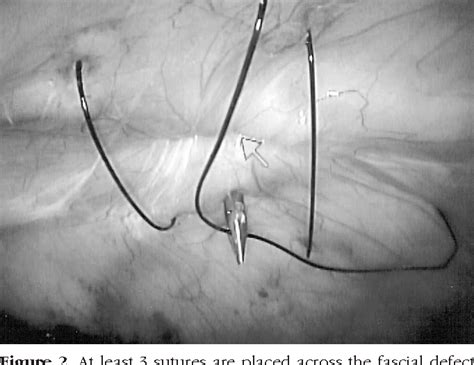 Figure 1 From Laparoscopic Repair Of Umbilical Hernias In Conjunction