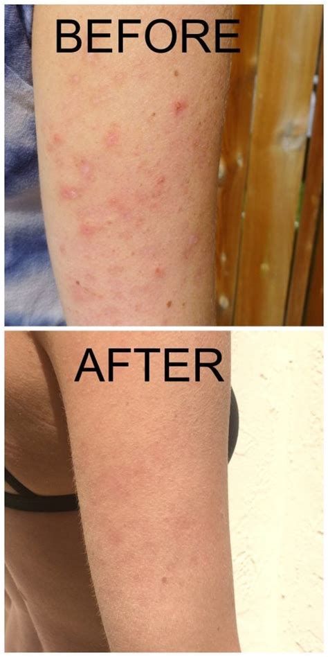 How To Heal Keratosis Pilaris Pilaris From The Inside Out Pure And Simple Nourishment