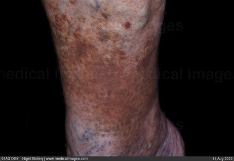 Stock Image Dermatology Hemosiderin Deposits A Spread Of Yellowish