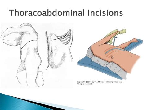 Surgical Incisions