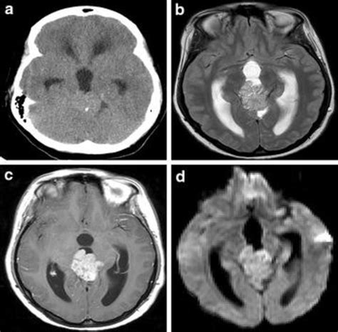 Ct Scan A Shows Homogenous Mass In Pineal Region With Peripheral