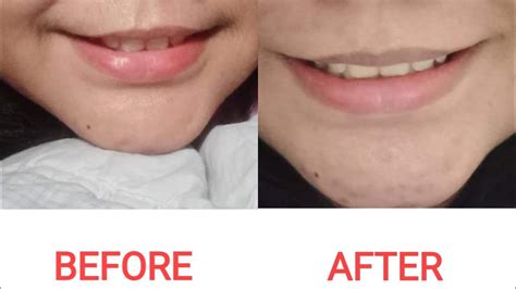 Upper Lip Laser Hair Removal Before And After Youtube