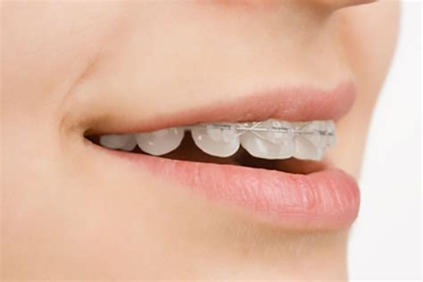 3 Reasons To Consider Clear Braces Henry Orthodontics Pinehurst