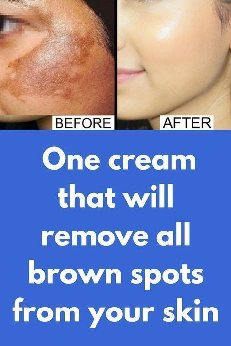 Maybe you would like to learn more about one of these? Pin on How To Get Rid Of Acne Scars