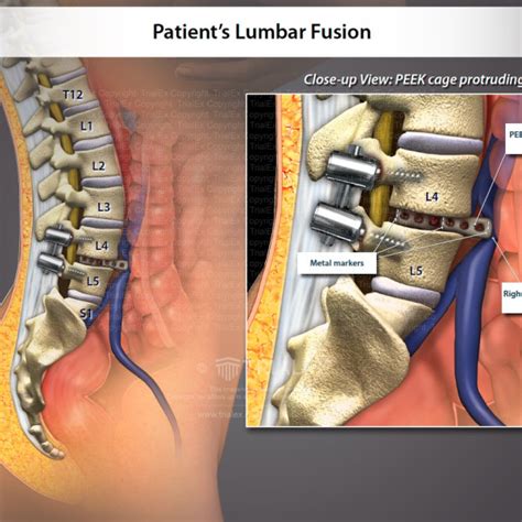 Lumbar Fusion Trialexhibits Inc