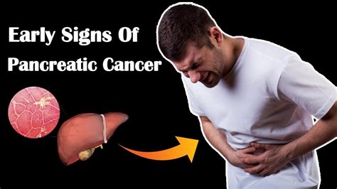 7 Early Signs Of Pancreatic Cancer Pancreatic Cancer Symptoms In Men And Women Youtube
