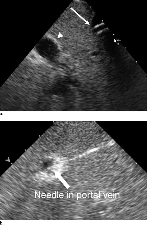 Transjugular Intrahepatic Portosystemic Shunt Creation Using Intravascular Ultrasound Guidance