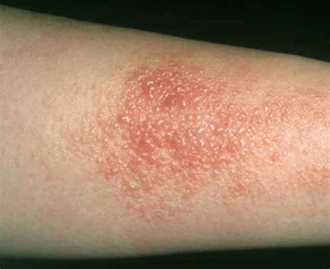 Contact Dermatitis Causes Symptoms And Prevention Contact