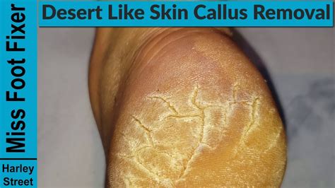 The Right Way To Remove Foot Callus Full Treatment 4 Part 1 Youtube