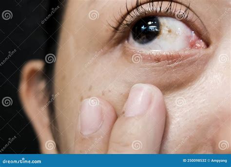 A Woman With Brown Spot On Her Eye Stock Photo Image Of Hemorrhagic