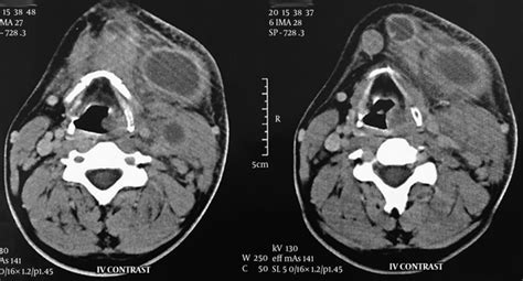 A Case Report Of Diffuse Large B Cell Lymphoma Masquerading As