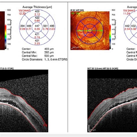 Oct During The First Visit Sub Retinal Fluid With Shagging Of