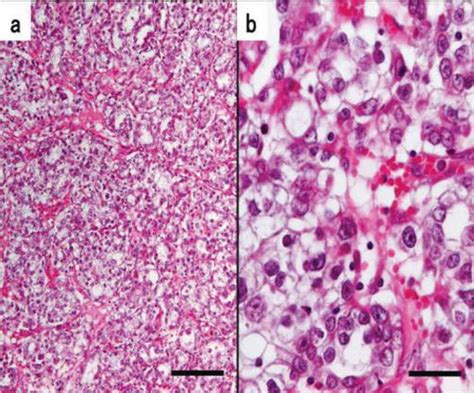 Ovarian Clear Cell Carcinoma Metastatic Pathways Intechopen