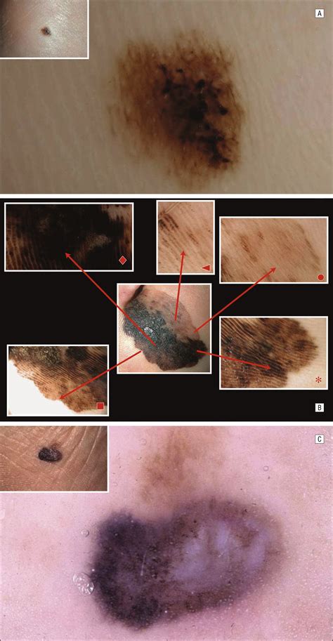 Dermoscopic Patterns Of Acral Melanocytic Nevi And Melanomas In A White