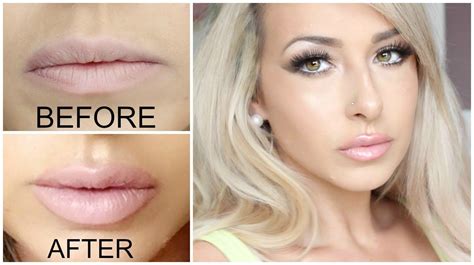 what to do before lip fillers whatdosg