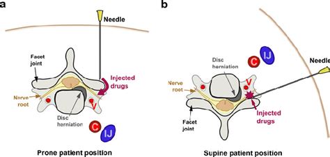 Schematic Figure Of Cervical Nerve Root Injections A Indirect Cervical